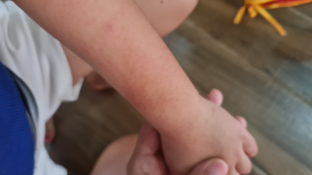 Our First HFMD&nbsp;Experience